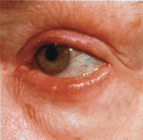 ocular rosacea symptoms