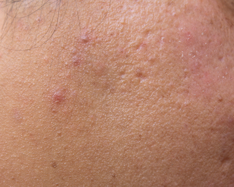 rosacea skin dermatitis seborrheic papules acne pustules care helps oily