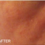 60 days after adding Rosadyn to rosacea treatment - minimization of facial redness, burning and rosacea triggers, along with medical treatment 2 tablets 2 times per day with food