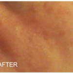 2a - rosacea symptoms reduced after 60 days by adding in Rosadyn to rosacea treatment reduction of redness, burning triggers and brakeouts.