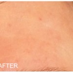 Results after adding in Rosadyn for treating rosacea to their daily rosacea treatment routine photo after 90 days
