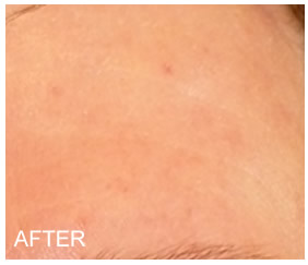 6 months after using Rosadyn natural rosacea treatment monthly, reduction in rosacea symptoms