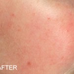 Minimization of rosacea red cheeks, buring flares and triggers after 90 days Rosadyn Rosacea Treatment Photos