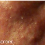 Advanced stage rosacea symptoms, burning, redness and brakeouts before Rosadyn 1