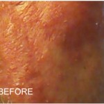 2 - rosacea acne like symptoms, redness, inflammation, burning on cheeks