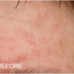Rosacea blotchy redness and itching on the forehead before adding Rosadyn photo