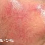 rosacea symptom of redness burning and flares on cheeks prior to adding Rosadyn for rosacea