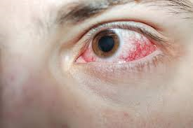 Broken blood vessels on ocular surface