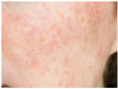 6 months after using Rosadyn natural rosacea treatment monthly, reduction in rosacea symptoms