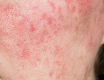 rosacea symptom of redness burning and flares on cheeks prior to adding Rosadyn for rosacea
