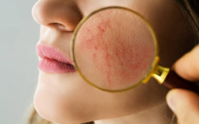 Rosacea and Sulforaphane: A Natural Approach to Calming Redness and Inflammation